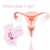 Reusable Menstrual Disc - Image 9